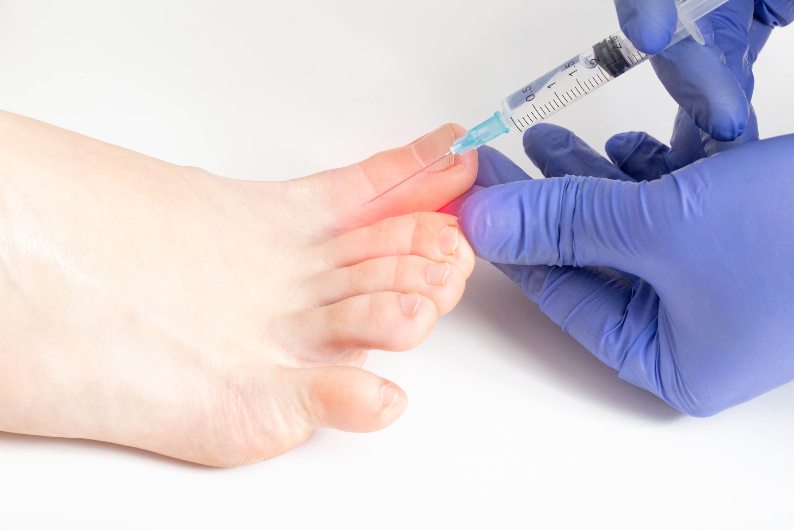 The doctor makes an injection between the toes against hyperhidrosis sweating. Unpleasant foot odor treatment concept, cosmetology